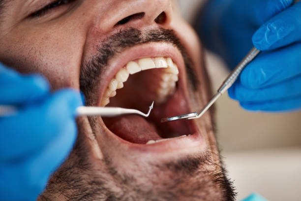 Best Emergency Treatment for Dental Infections or Abscesses in South Pasadena, FL